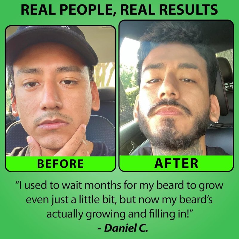 Minoxidil Beard Growth Serum - 5% Formula with 2X Biotin & Rice Water for Thicker, Fuller Facial Hair | Ideal for Patchy Areas