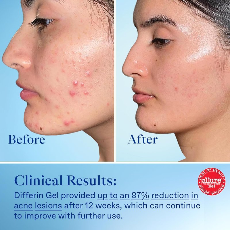Differin Acne Treatment Gel - 0.1% Adapalene Retinoid for Sensitive Skin | 15g Tube (Pack of 2)