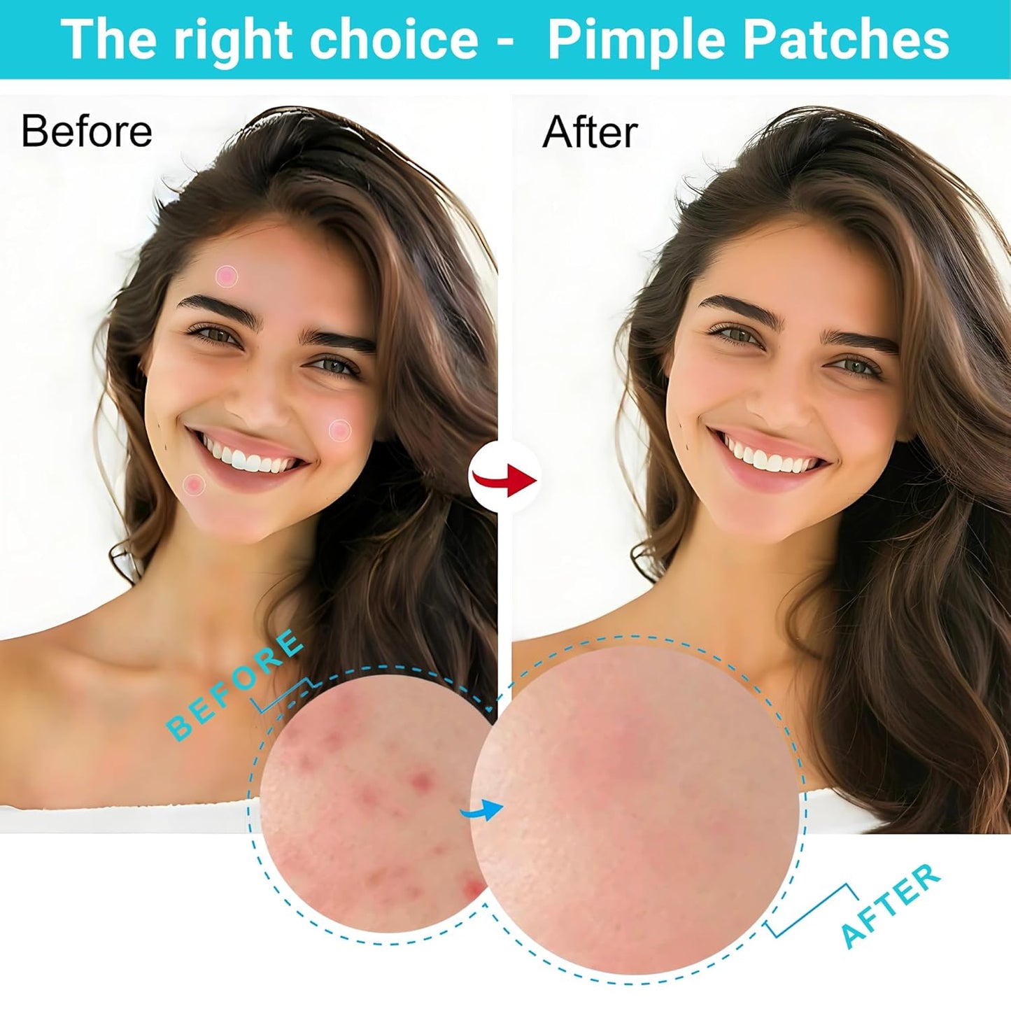 Hydrocolloid Acne Patches - Clear Pimple Patch with Salicylic Acid & Tea Tree Oil | 96 Count, 3 Sizes