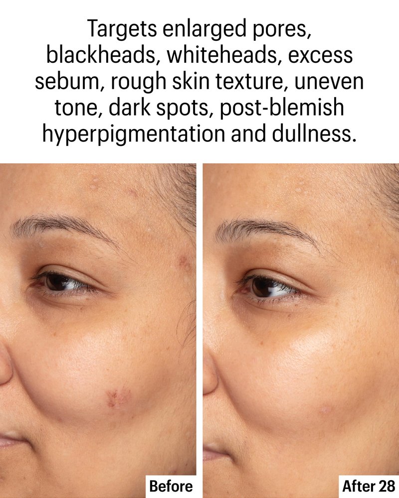 Allies of Skin Azelaic & Kojic Clarifying Face Serum | Clinically Proven for Acne & Blemish Prone Skin |10% Azelaic Acid Treats Pigmentation and Redness | Targets Pores & Uneven Skin Texture (1 Fl oz)