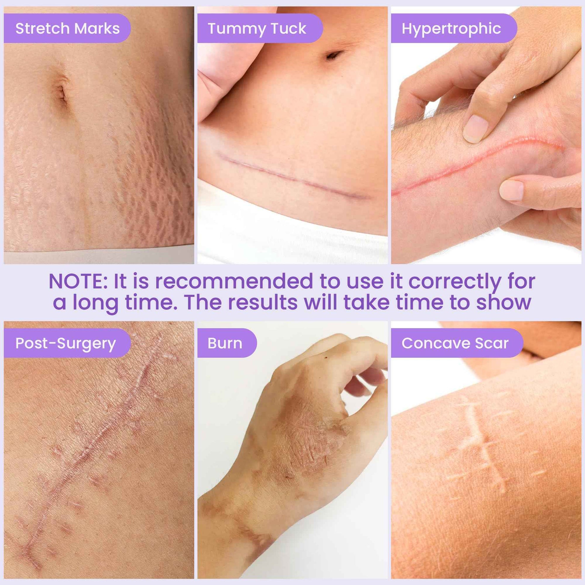 Antaly Silicone Scar Sheets, Silicone Scar Tape, Medical Grade Skin Patches for Surgical Scars, Keloid Bump Removal, C-Section, Stretch Marks, Hypertrophic, Post-Surgery-1.6"X 79" Roll, 2M