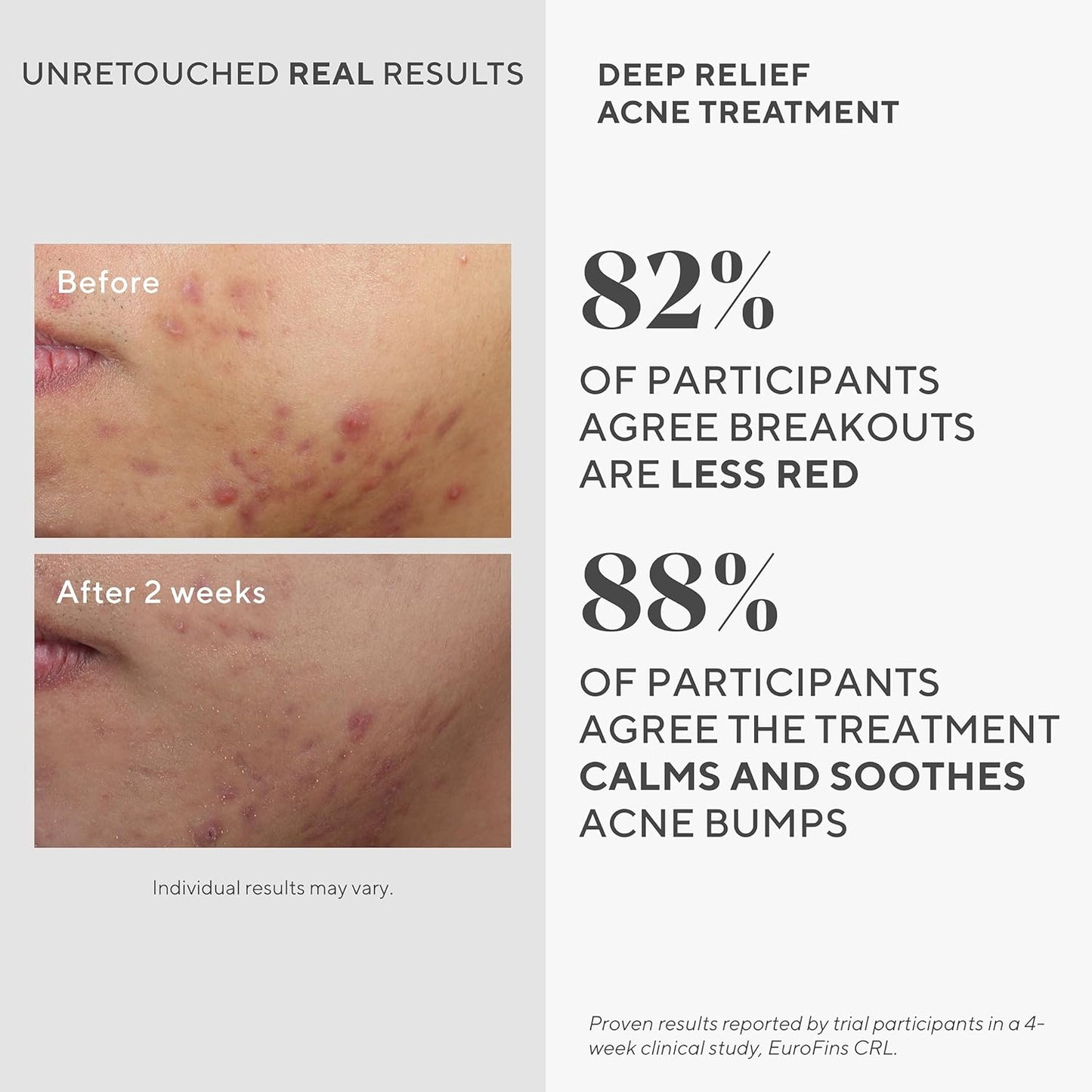 Murad Acne SOS Dual Treatment Combo - Maximum Strength Spot Treatments for Rapid Relief | Set of 2