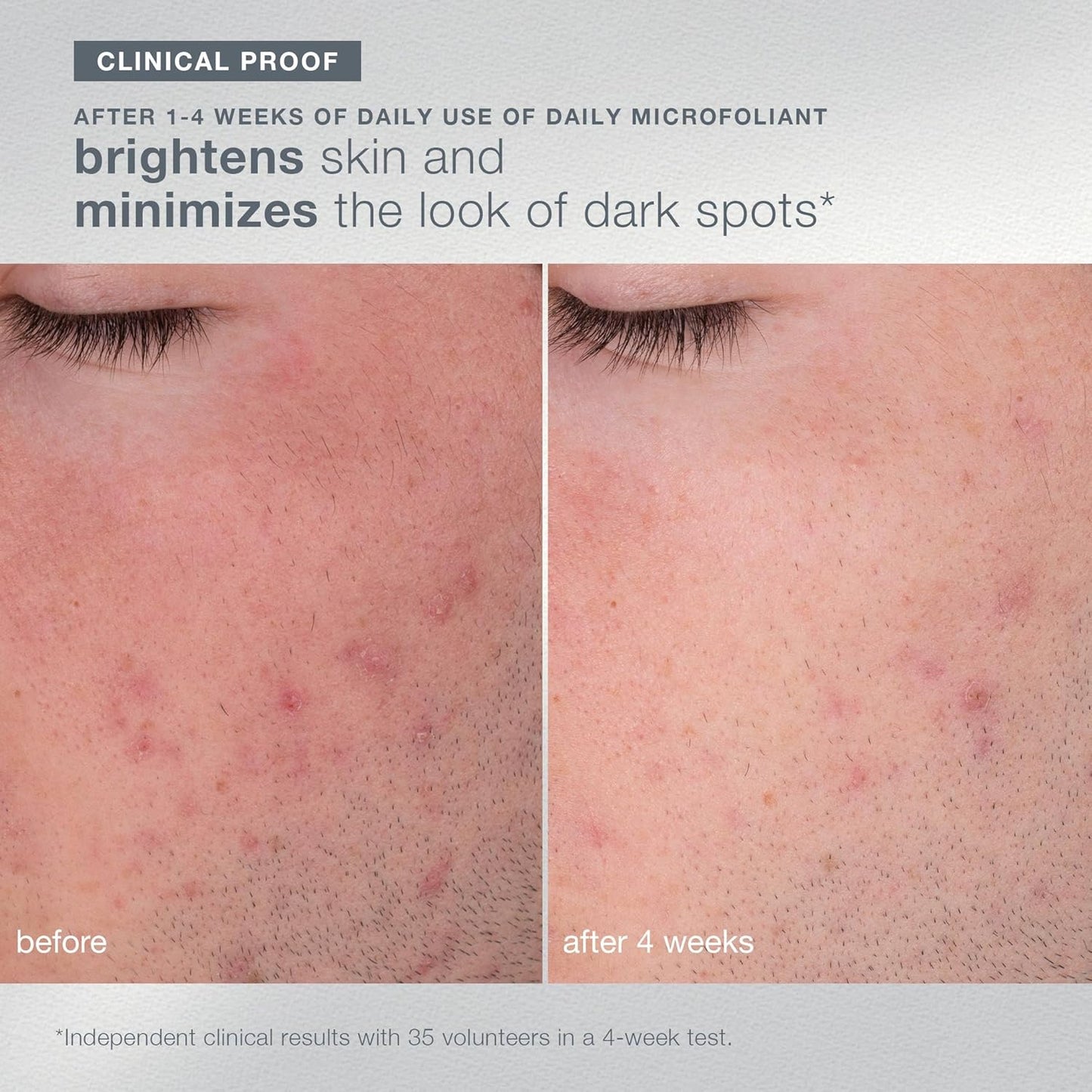 Dermalogica Travel-Sized Skin Care Set | Exfoliants, Serum & SPF Moisturizer for Radiant Skin