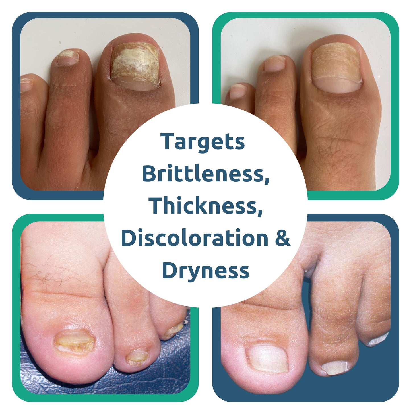 Nail Renewal Gel, Discoloration, Thickened Nails, Cracking, Brittle Nails, Fast 2-Day Results
