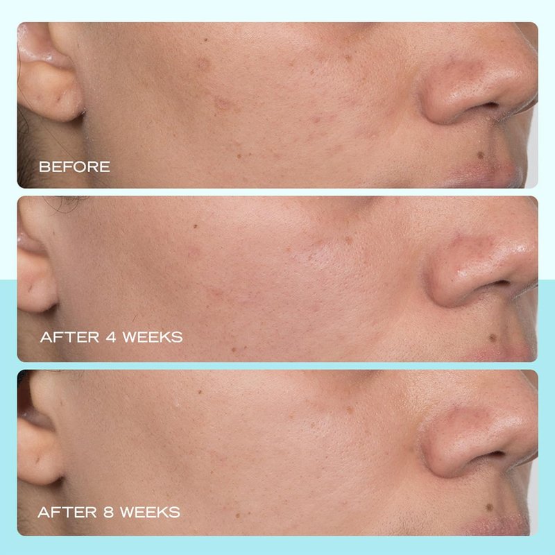 First Aid Beauty Dark Spot Serum - Niacinamide for Hyperpigmentation & Discoloration | 1 oz