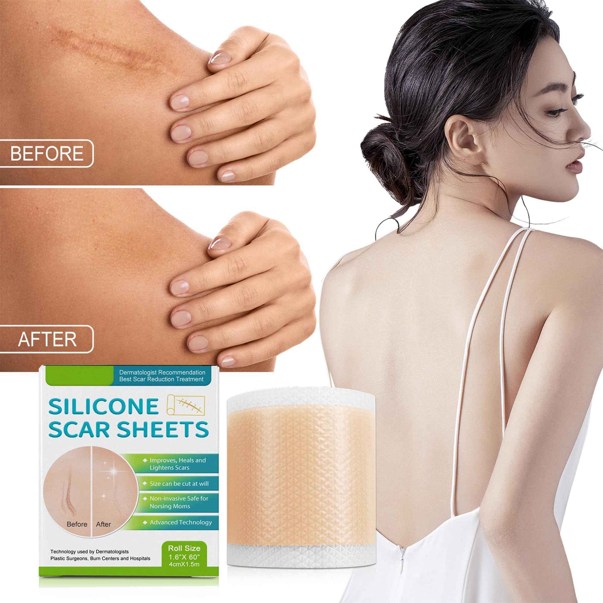 Silicone Scar Sheets - Suitable for Repair of Caesarean Section, Abdominoplasty, Keloid and Surgical Scars(1.6”x 60”)