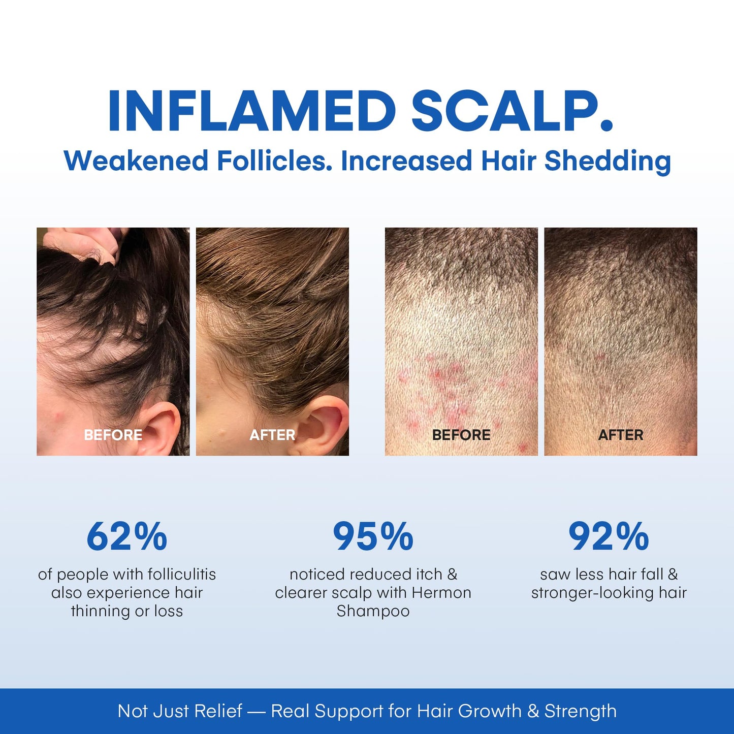 Hermon Folliculitis Treatment (2 Packs Folliculitis Shampoo)