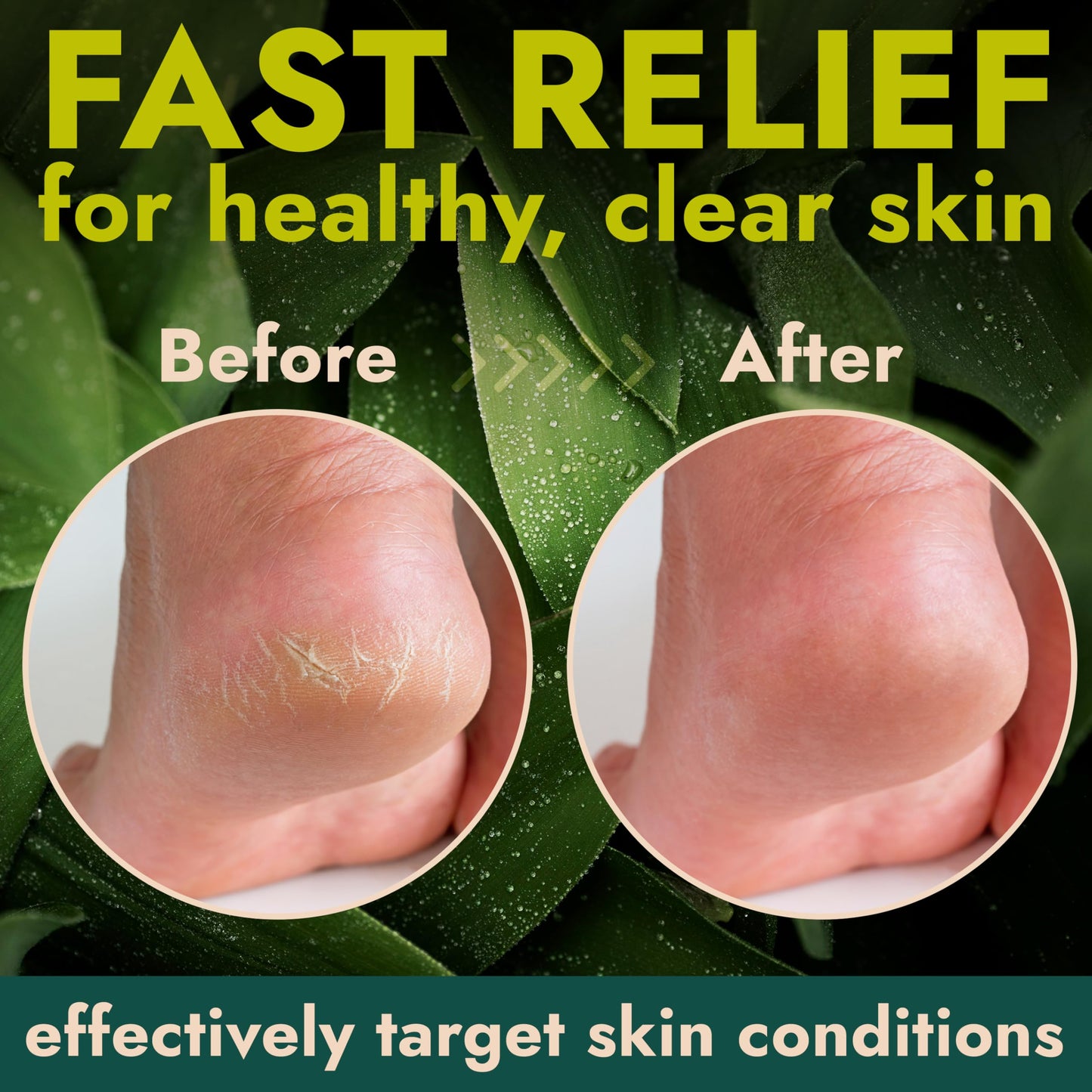 Foot Cream with Tea Tree Oil | Antifungal Cream to Soothes Cracked Heels, Dry Skin & Itchy Feet | Helps with Athlete’s Foot, Nail Fungus & Jock Itch | Relieves Itching & Burning | 4.05 fl oz