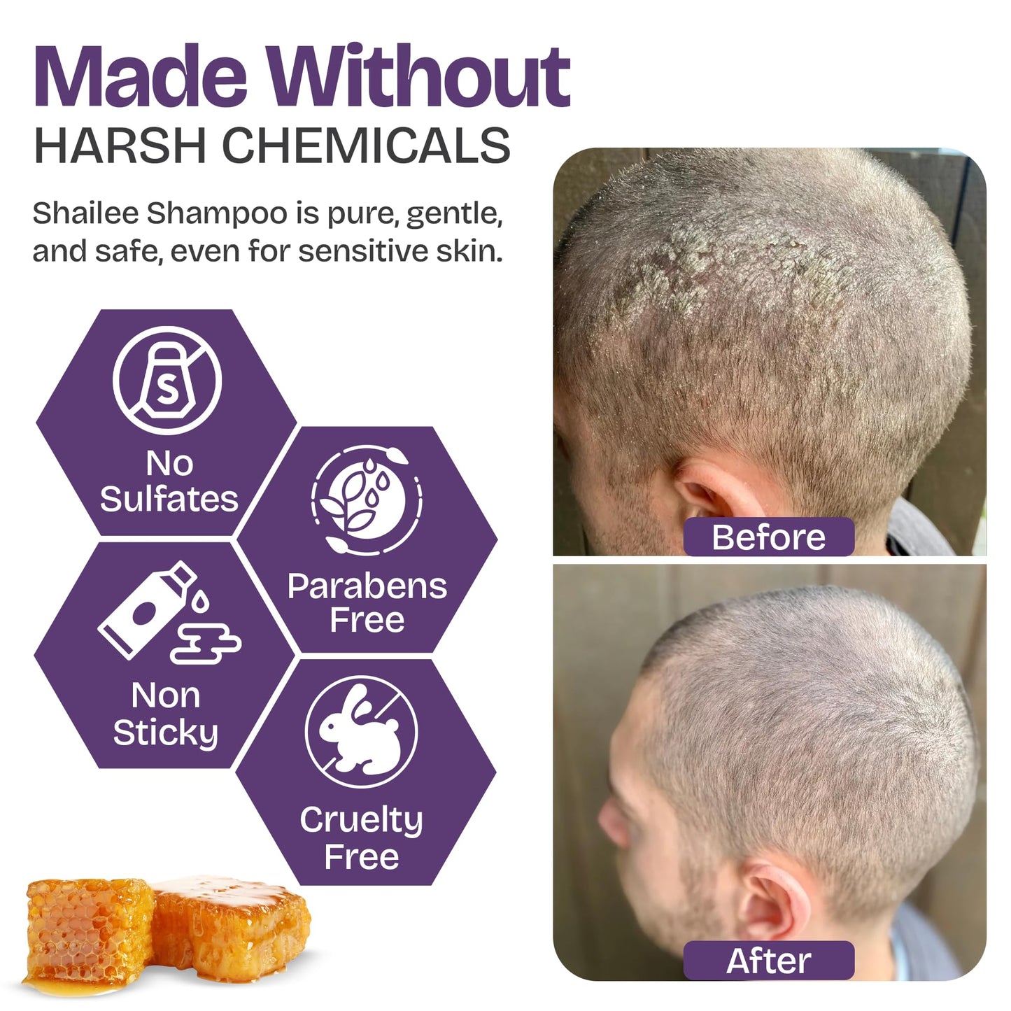 Psoriasis Shampoo with Scalp Scrubber for Eczema & Folliculitis Treatment - Seborrheic Dermatitis Antifungal Shampoo for Ringworm, Acne, Flaking, Dry & Itchy Scalp - Psoriasis Relief with Manuka Honey