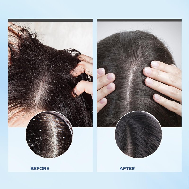 Bablabear Scalp Exfoliator Scrub,Itchy Scalp Treatment for Dandruff, No Sulfate Hair Scrub To Soothe a Dry, Flaky,Scalp,Removes Buildup,Clarifying Shampoo.