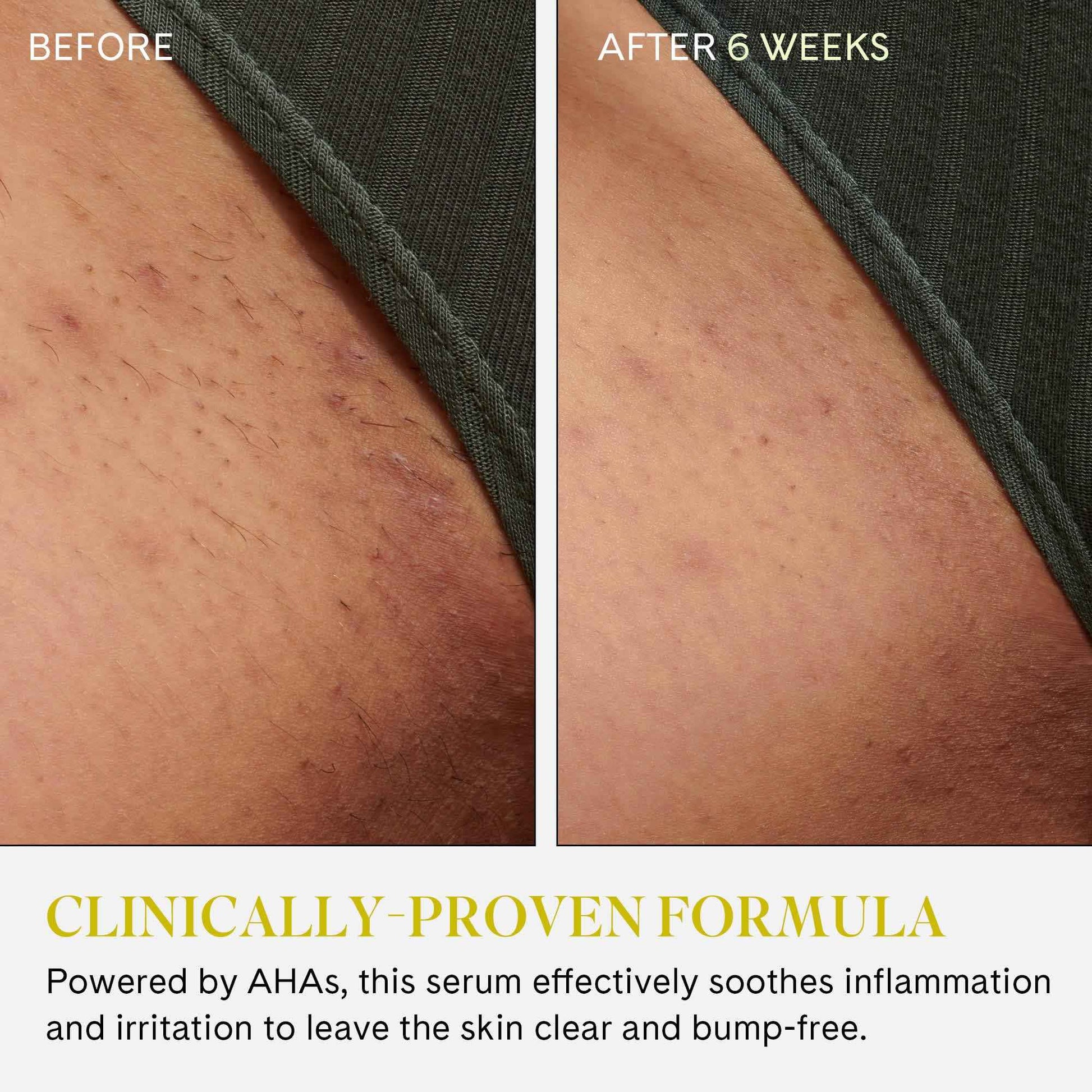 Fur Ingrown Eliminator Serum Rollerball Travel Size - Powerful Ingrown Hair Treatment Serum With AHAs and BHAs to Treat and Prevent Ingrown Hairs and Bumps, Hydrates and Soothes Irritated Skin - 10 ml