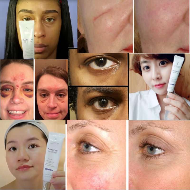 Anacis Vitamin K1 Oxiderm Cream Minimizing Appearance of Old and New Scars, Dark Eye Circles, Bruises, Varicose Veins, Redness Relieve 1.01Oz