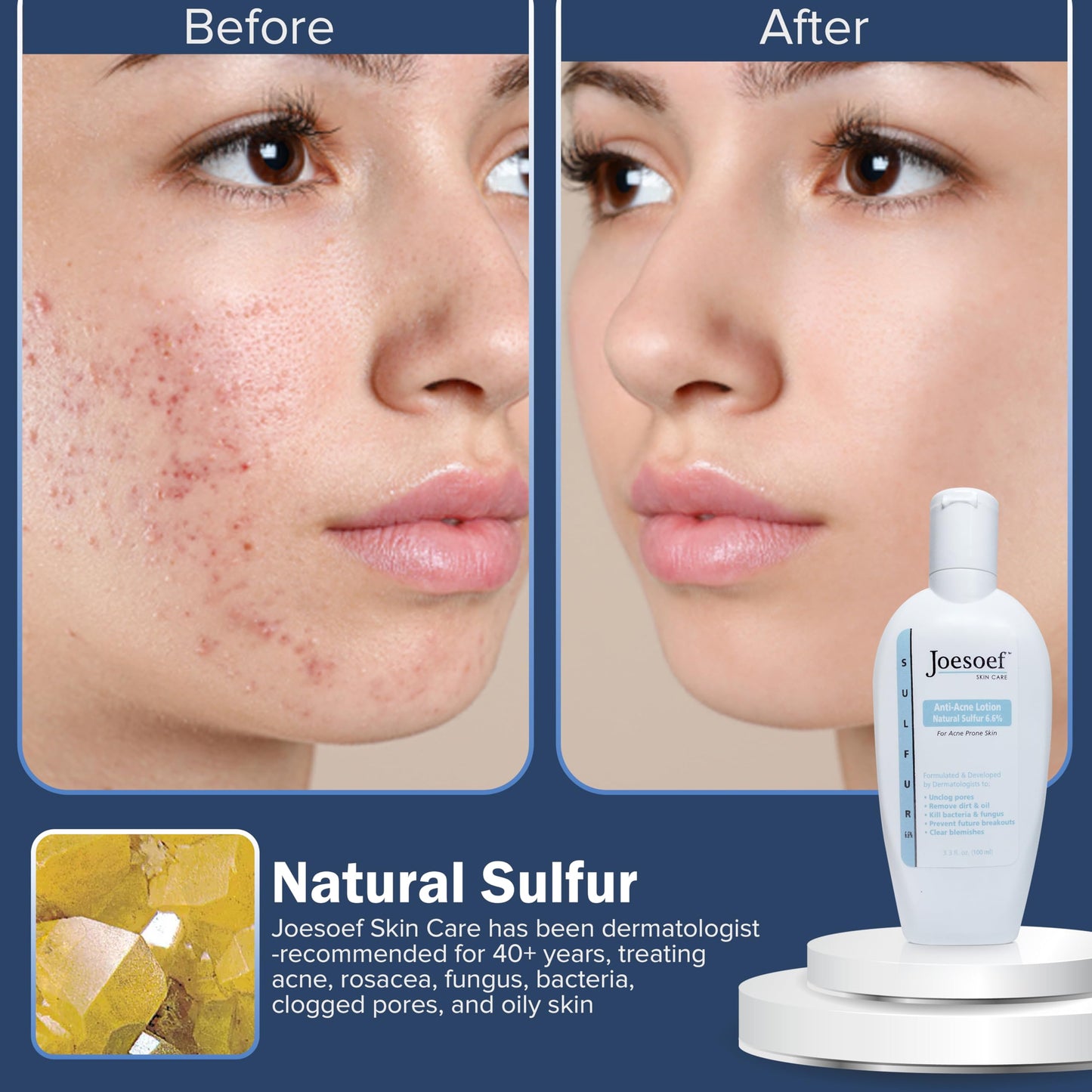 JOESOEF SKIN CARE Sulfur Soap for Acne Pharmaceutical Grade Dermatologists Approved for Acne Rosacea. Sulfur Acne Treatment for Skin Care Daily Routine. (2pack)
