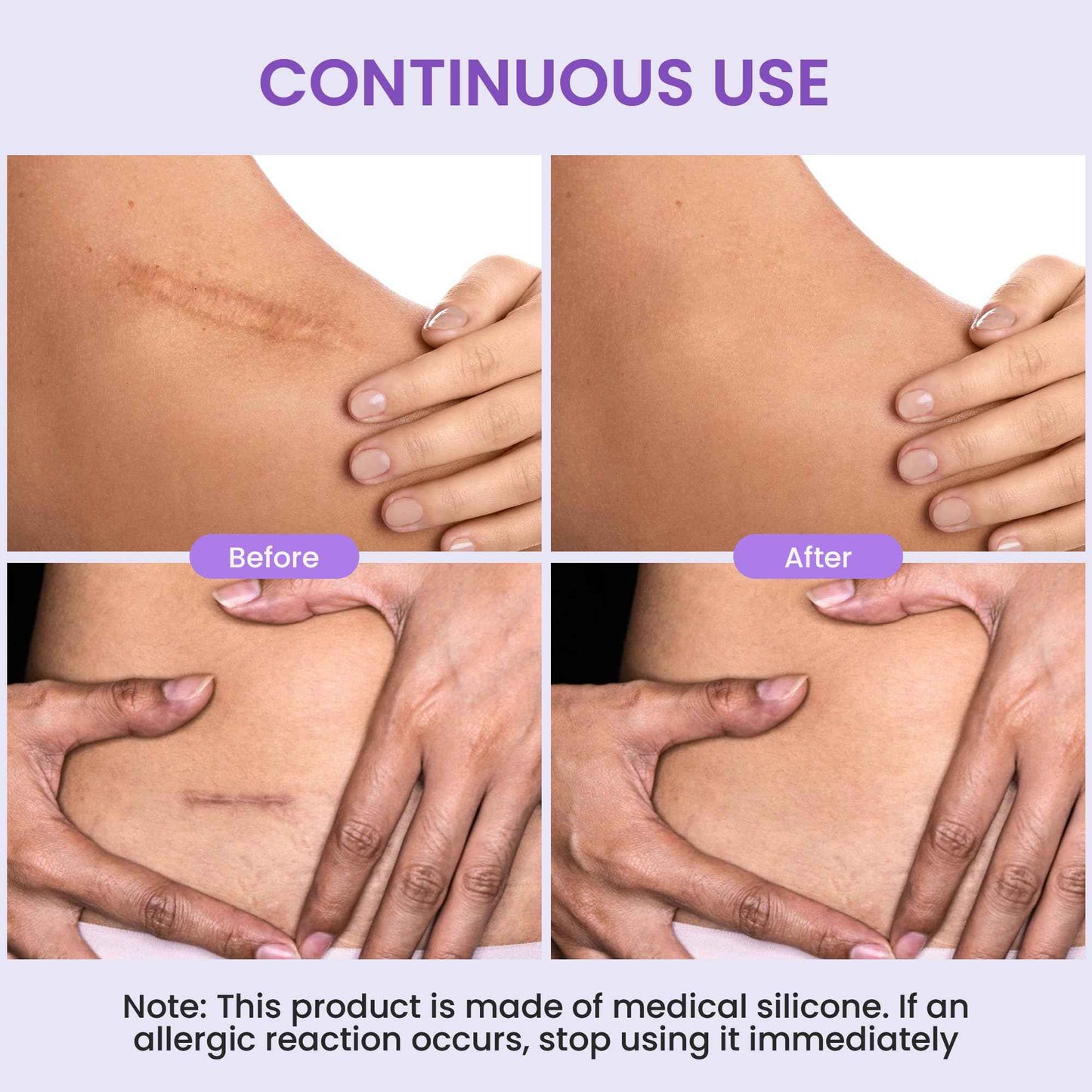 Antaly Silicone Scar Sheets, Silicone Scar Tape, Medical Grade Skin Patches for Surgical Scars, Keloid Bump Removal, C-Section, Stretch Marks, Hypertrophic, Post-Surgery-1.6"X 79" Roll, 2M