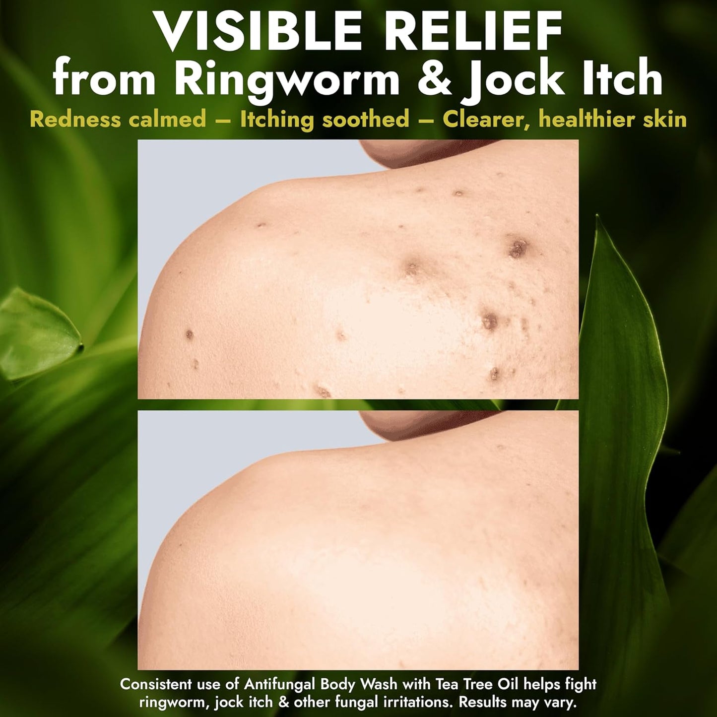 Antifungal Body Wash with Tea Tree Oil - Treat Back Acne, Ringworm & Eczema | Includes Silicone Scrubber (16.9 oz)