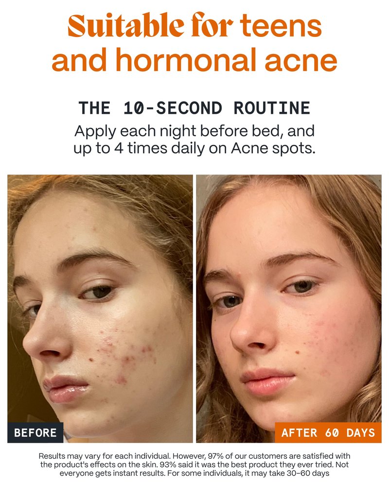 Norse Organics | The Complete System For Pimples | 3 Step System with Day Glow Balm, Acne Night Balm, Face Scrub | Natural Face Care with Arctic Herbs & Beeswax for Teens & Adults (3 pc kit)
