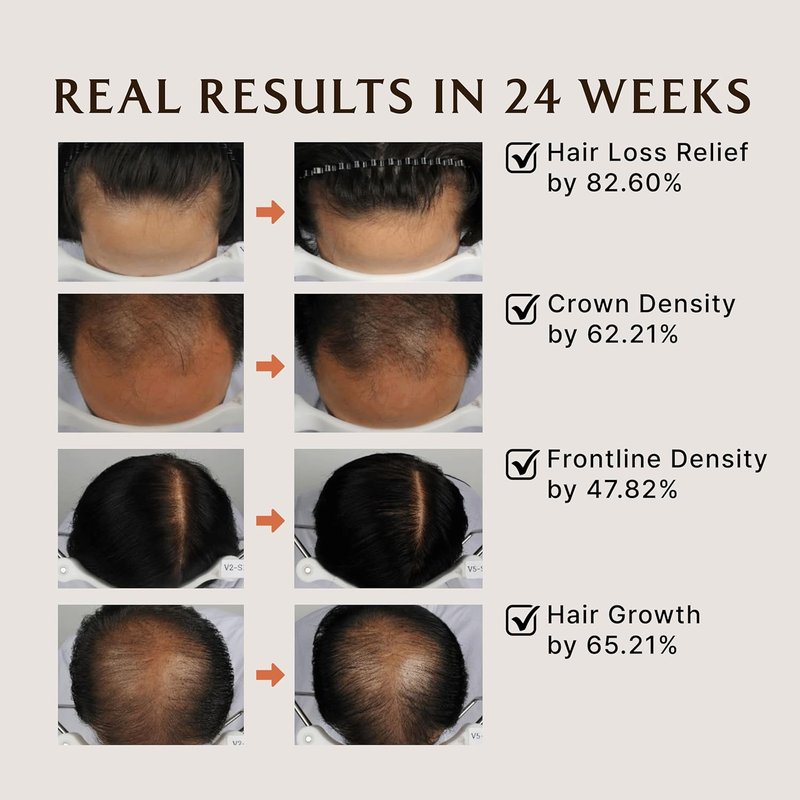 LADOR Anti Hair Loss Shampoo - Nourishing Hair Growth Formula with Salicylic Acid & Niacinamide | 17.9 Fl Oz for Normal to Dry Hair