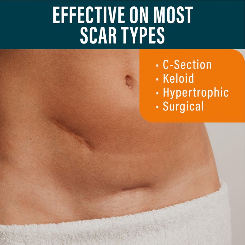 NUVADERMIS Silicone Scar Sheets – Extra Long Medical-Grade Scar Sheets for C-Section, Tummy Tuck, Keloid, and Surgical Scars – Reusable and Effective – Pack of 4 – Medium Tone