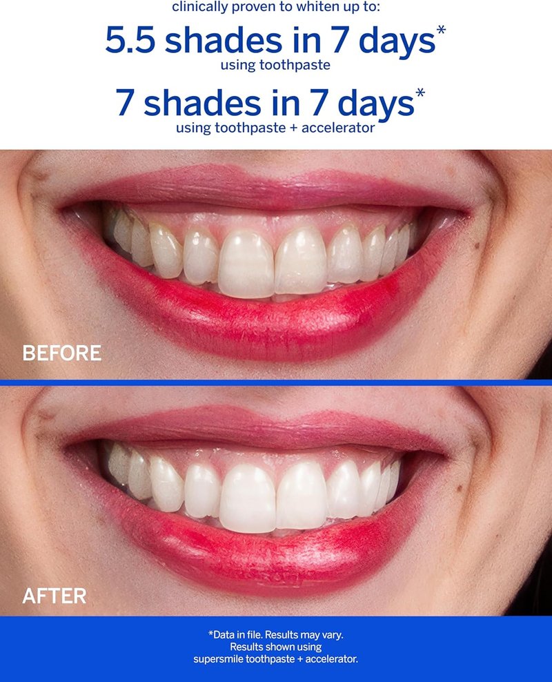 Supersmile Fluoride-Free Whitening Kit | Professional Grade Toothpaste & Toothbrush - Whitens Up to 6 Shades, 1.4 oz