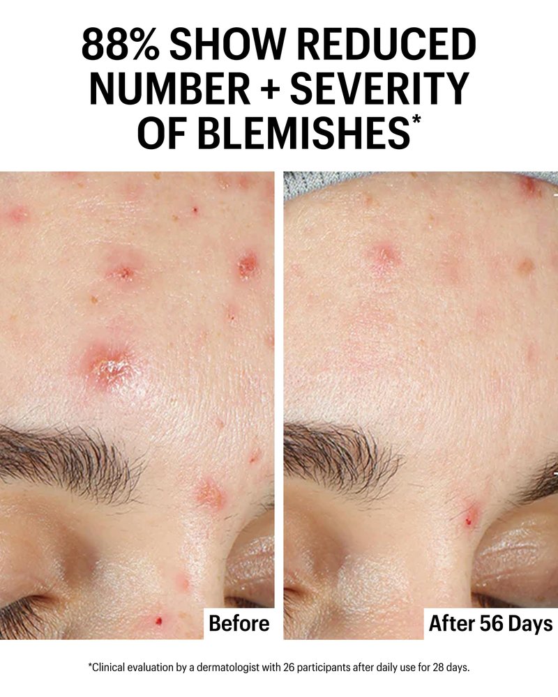 Allies of Skin Azelaic & Kojic Clarifying Face Serum | Clinically Proven for Acne & Blemish Prone Skin |10% Azelaic Acid Treats Pigmentation and Redness | Targets Pores & Uneven Skin Texture (1 Fl oz)