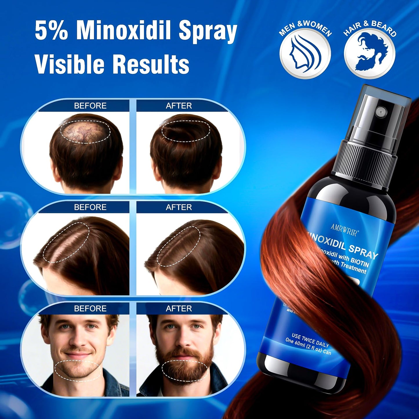 5% Minoxidil Spray for Men and Women,Infused with Biotin, Hair Growth Treatment,Topical hair growth serum,Supports Thicker and Fuller Hair & Beard (6 Pcs,12 Fl Oz Total,6 Month Supply)