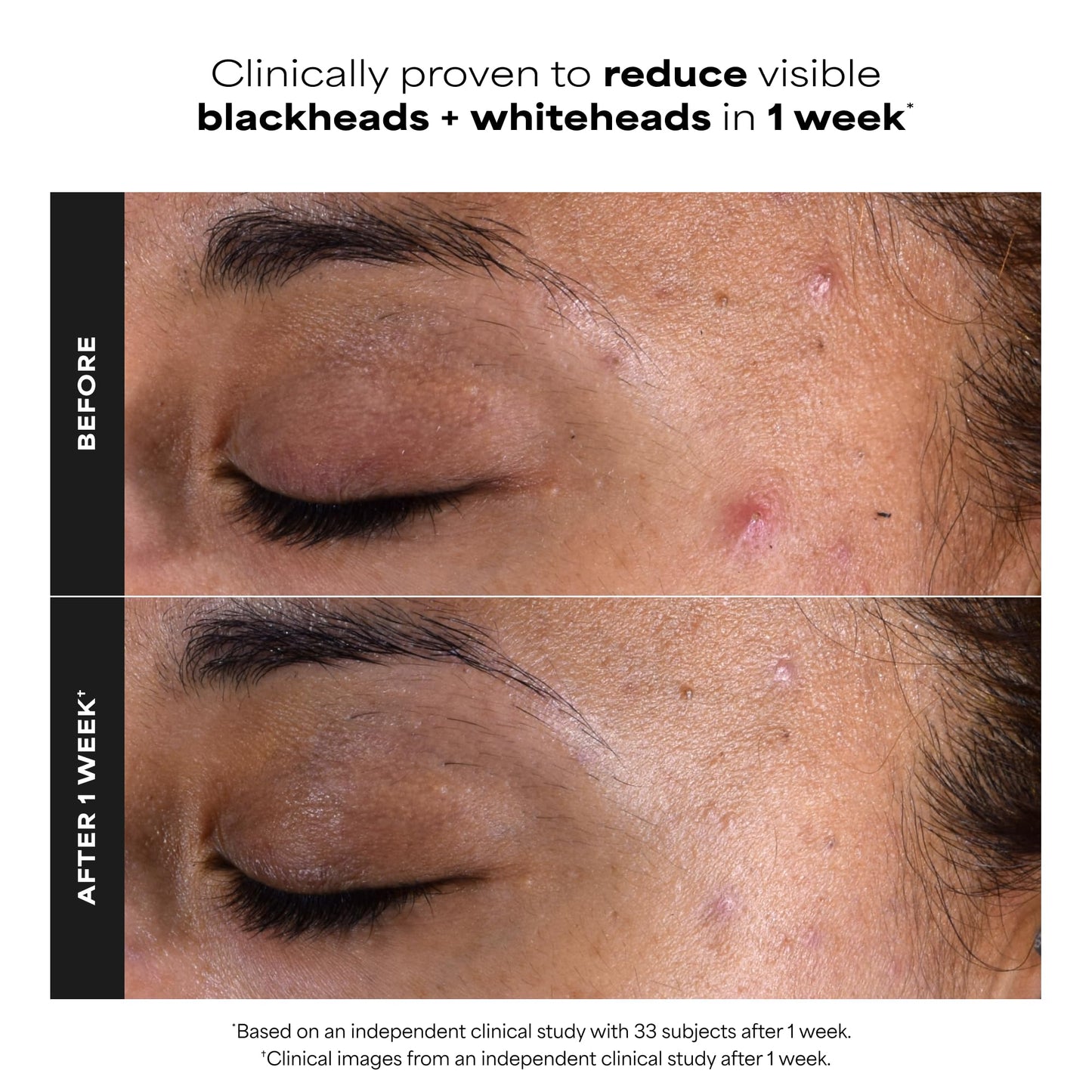 Paula's Choice SKIN PERFECTING 2% BHA Salicylic Acid Exfoliating Pads,10 Ct