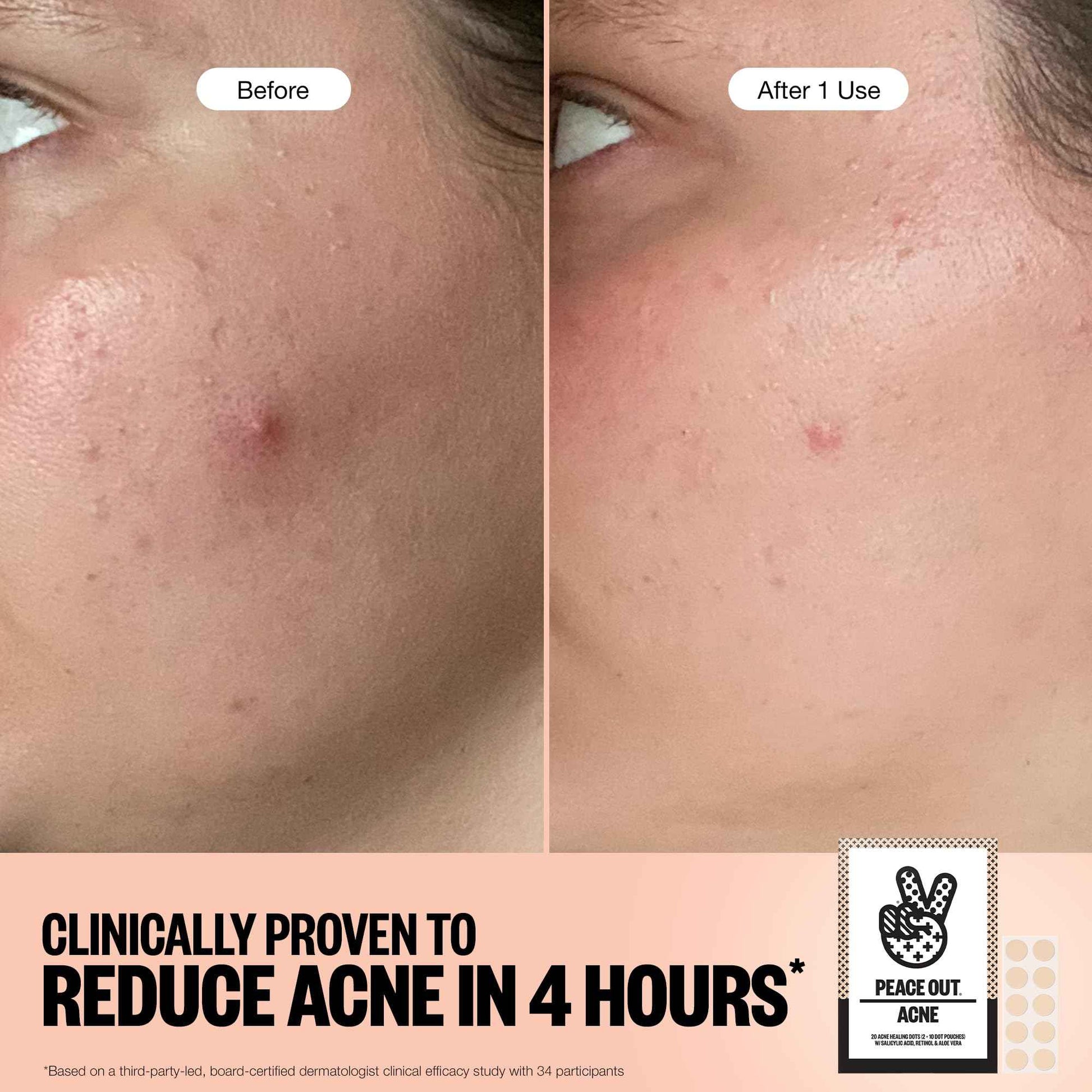 PEACE OUT Acne Healing Dots Helps Clear Blemishes Overnight, Fast Acting Hydrocolloid Pimple Patches for Breakouts with Salicylic Acid, Retinol and Aloe Vera, Award Winning Skincare Solution 20 Count