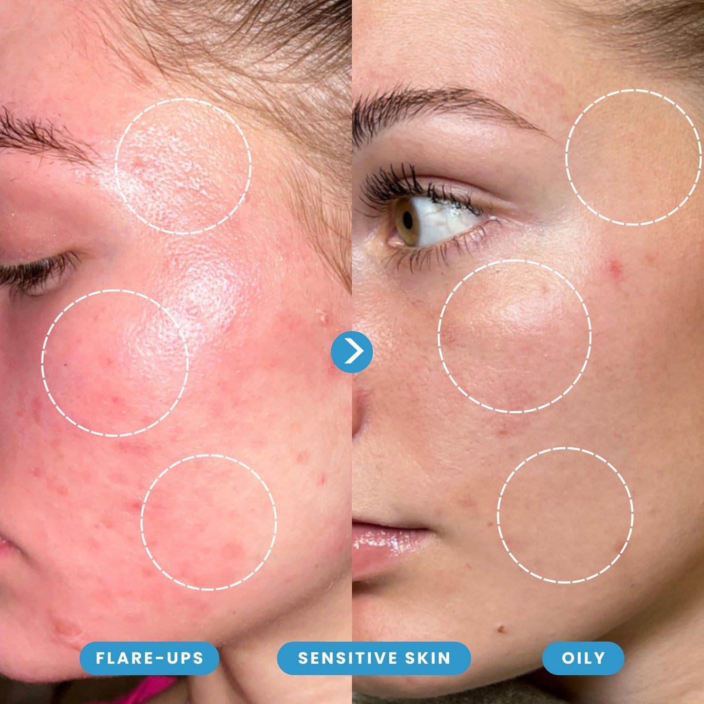 Hypochlorous Acid Spray – Dermatologist Tested HOCl Facial Cleanser for Sensitive, Acne-Prone & Irritated Skin Soothes Redness, Eczema, Rashes & Itching – Skin Repair Spray, 2oz + 6.8oz, Honeydew Labs
