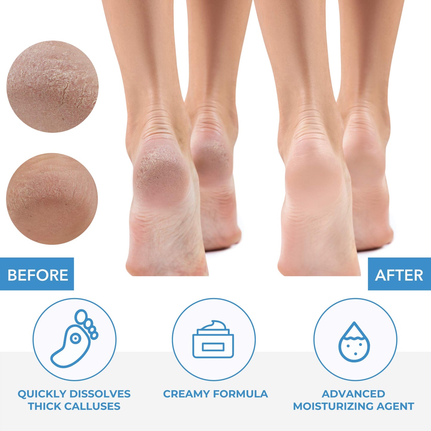 ForPro Professional Collection Premium Callus No More! Callus Remover, Fast-Acting Callus Removing Formula, 32 oz.