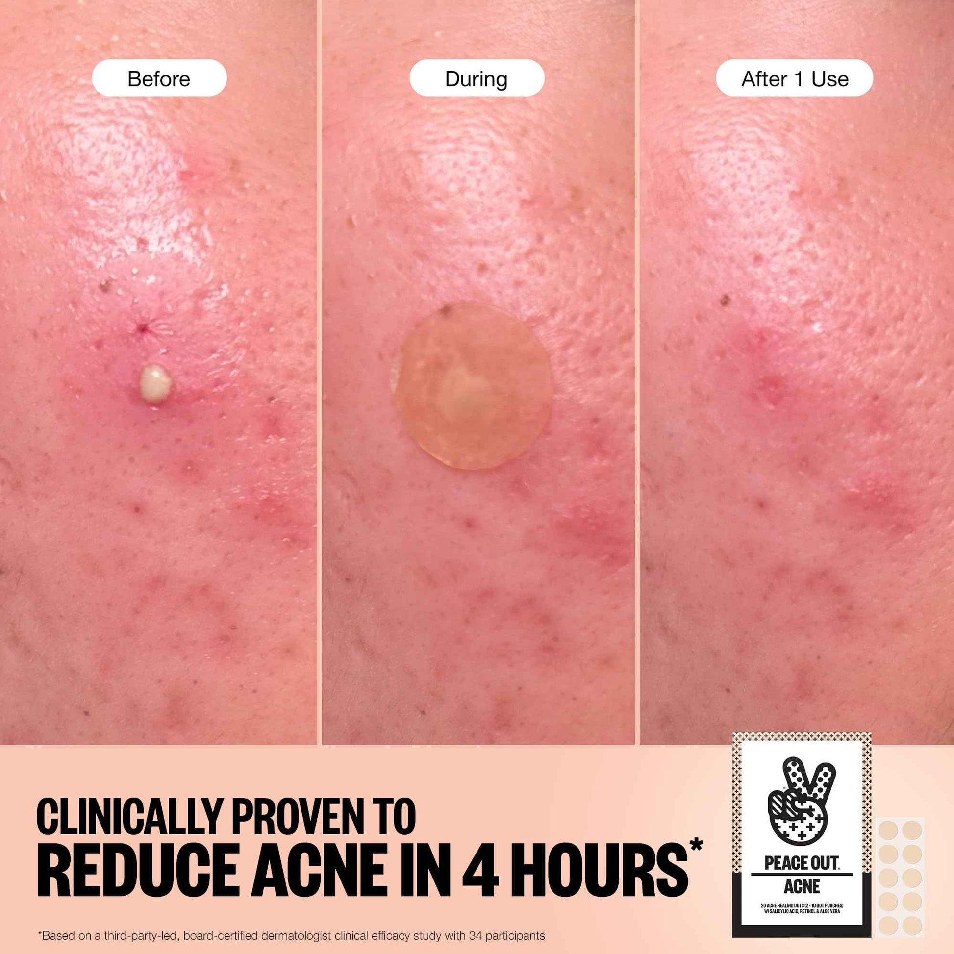 PEACE OUT Acne Healing Dots Helps Clear Blemishes Overnight, Fast Acting Hydrocolloid Pimple Patches for Breakouts with Salicylic Acid, Retinol and Aloe Vera, Award Winning Skincare Solution 20 Count