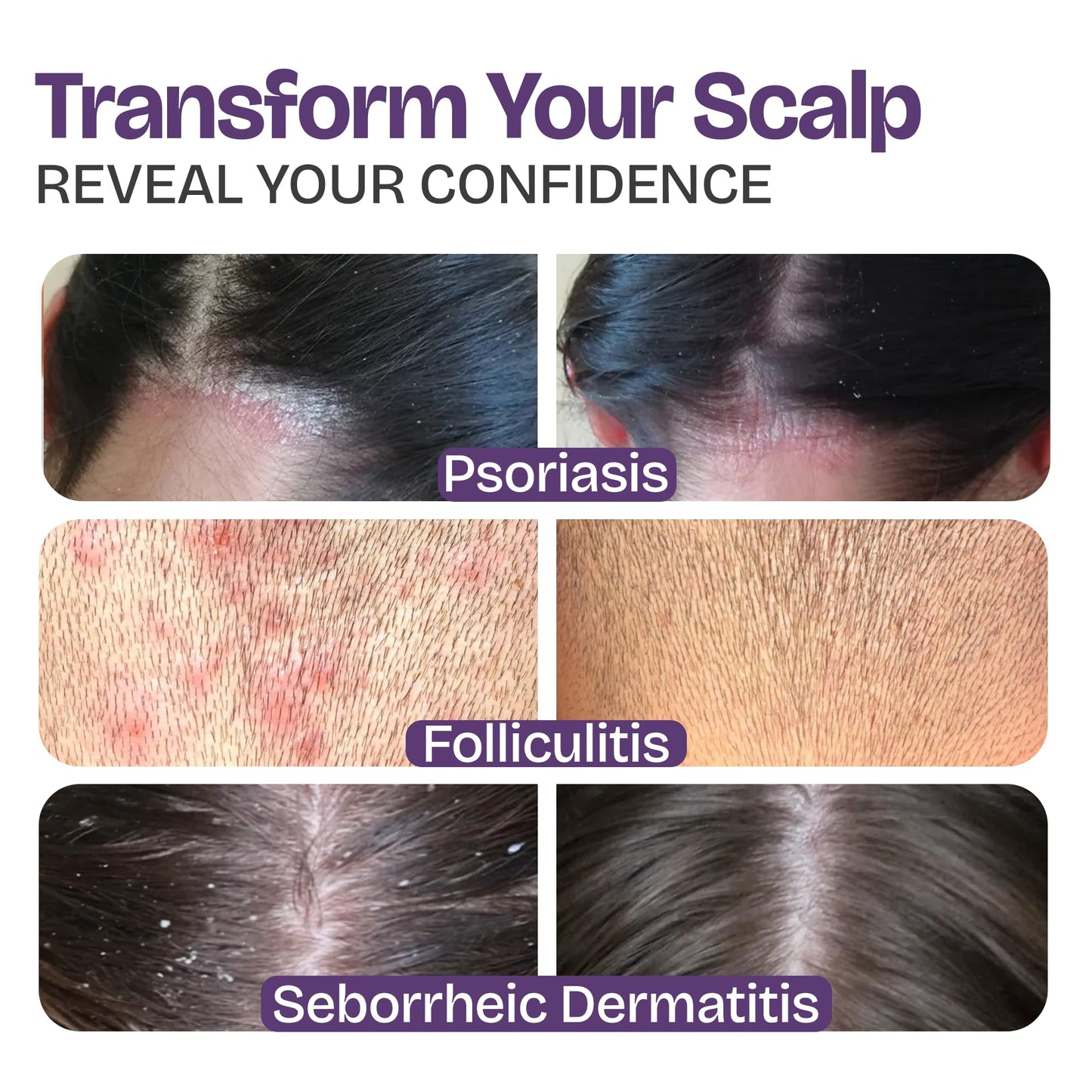 Psoriasis Shampoo with Scalp Scrubber for Eczema & Folliculitis Treatment - Seborrheic Dermatitis Antifungal Shampoo for Ringworm, Acne, Flaking, Dry & Itchy Scalp - Psoriasis Relief with Manuka Honey