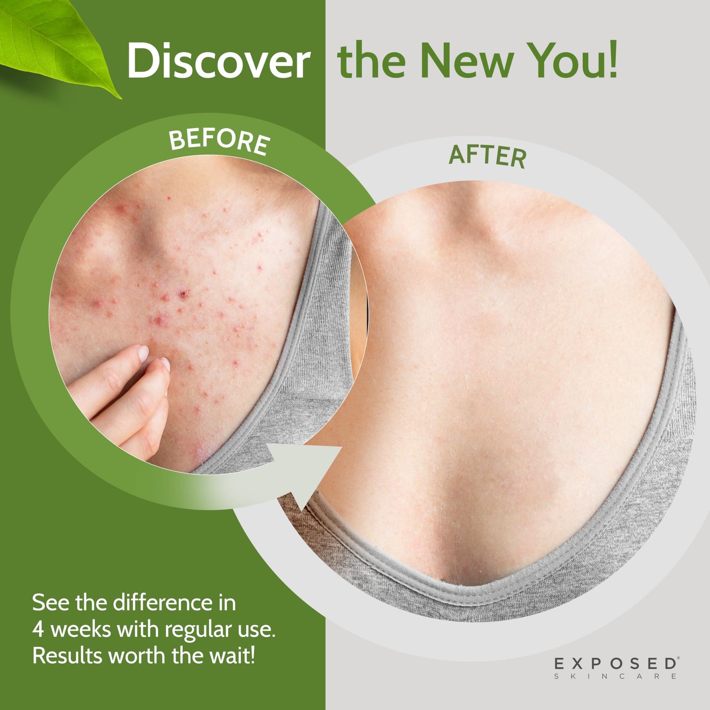 Exposed Skin Care, Body Acne Wash with Salicylic Acid, Glycolic Acid and Tea Tree Oil – Tri-Powered Gentle Exfoliating Cleanser for Back, Chest and Body Acne – Natural, Non-toxic and Cruelty Free