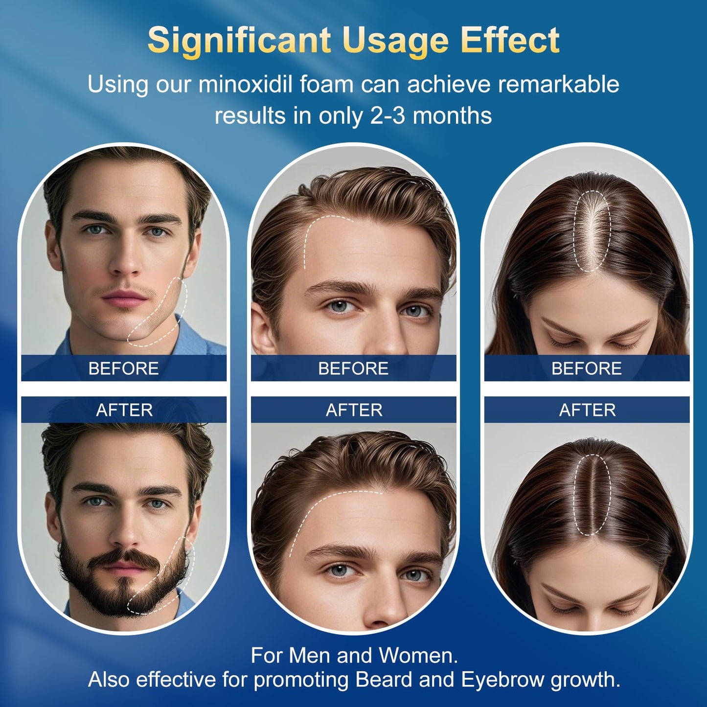 5% minoxidil foam for men-Free new applicator for minoxidil foam， Infused with Biotin, Hair Growth Treatment, Supports Thicker and Fuller Hair & Beard (10.5oz, 5 Month Supply)