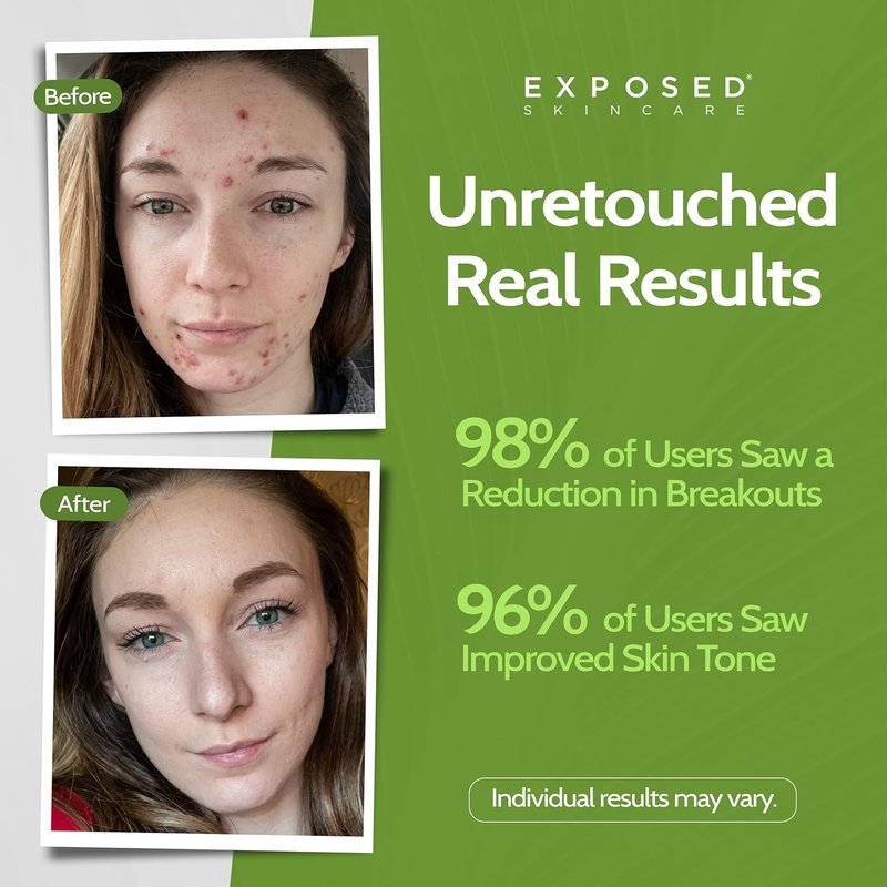 Acne Treatment Mask - 3% Sulfur & Activated Charcoal | Oil Control for Teen & Adult Acne