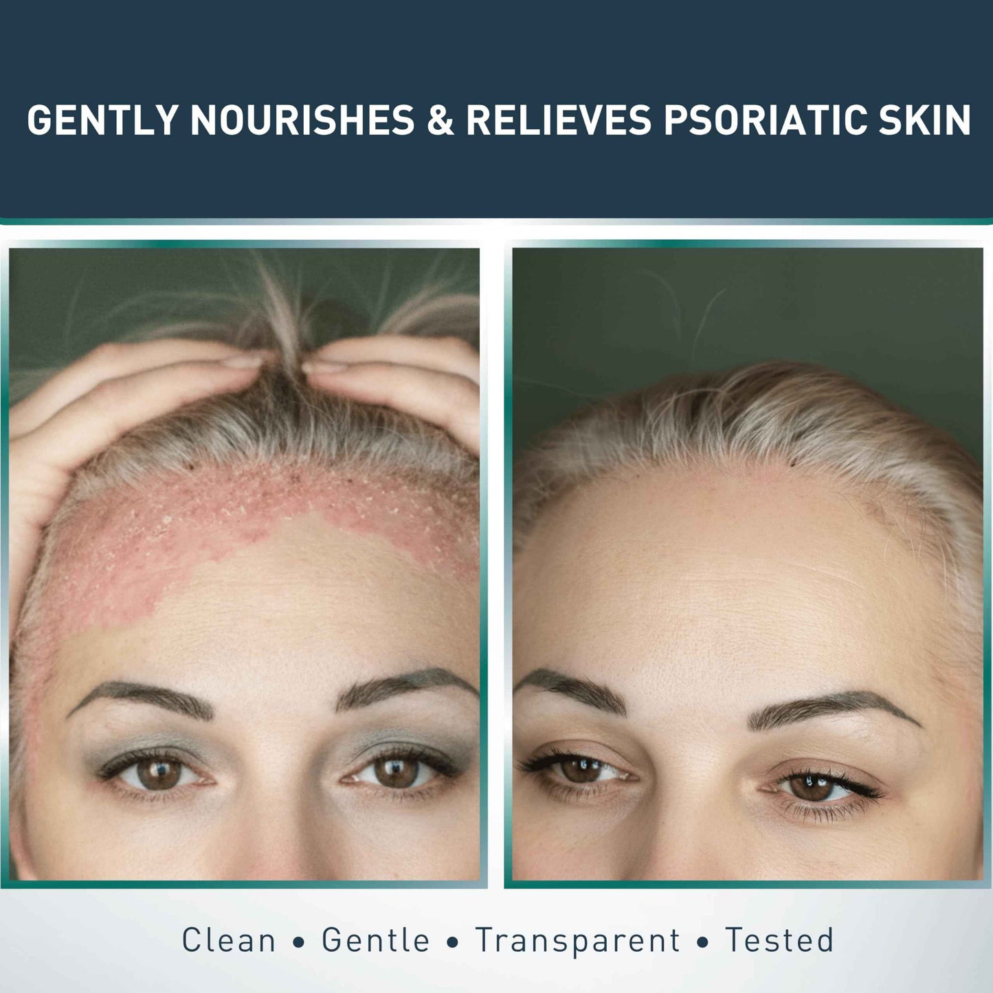 Jericho Psoriasis Dead Sea Salt Soap Bar with Olive Oil & Witch Hazel, Natural Exfoliating Face & Body Cleansing Bar for Sensitive Skin, 4.4 Oz / 125 g (Pack of 6)