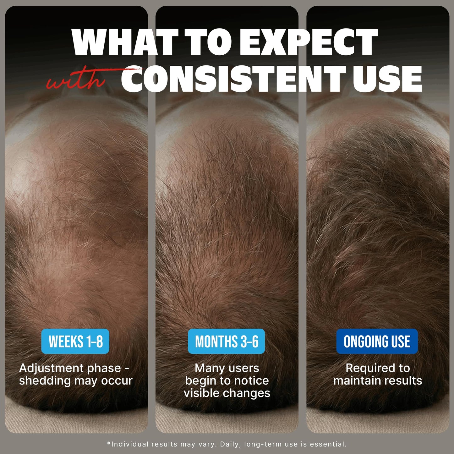 Kirkland Signature Minoxidil Topical Solution USP 5%, Extra Strength Hair Regrowth Treatment for Men, 6 Months Supply
