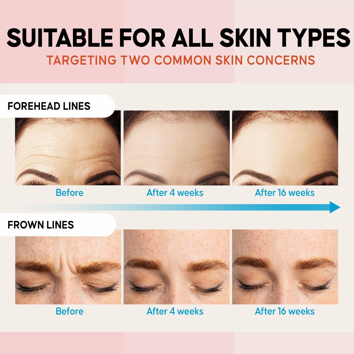 Forehead Wrinkle Patches Overnight: Anti-Wrinkle Facial Masks, Face Tape with Hydrolyzed Collagen - Forehead Lines Remover for Smoothing Fine Lines