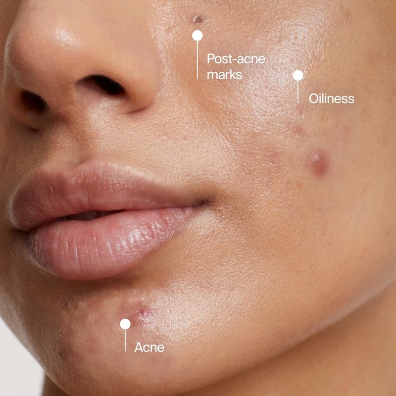Neutrogena Evenly Clear Acne Cleansing Face Mask - 3.5% Benzoyl Peroxide & Bentonite Clay | 4.2 fl. oz for Clearer Skin