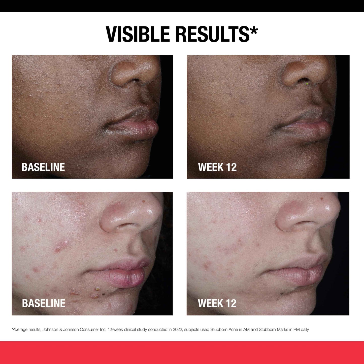 Neutrogena Retinol SA, Stubborn Marks PM Treatment, Face-Exfoliating Treatment to Help Reverse the Look of Post-Acne Marks & Uneven Skin Tone, Non-Comedogenic, PM Treatment, unscented, 1.0 Fl Oz