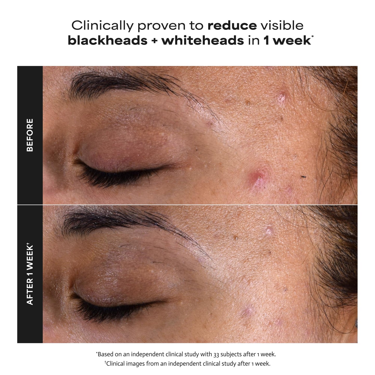 Paula's Choice SKIN PERFECTING 2% BHA Liquid Exfoliant with Salicylic Acid, Facial Polish for Pores, Wrinkles & Fine Lines, Suitable for Blackhead-Prone Skin, Fragrance-Free (5 Fl Oz (Pack of 2))