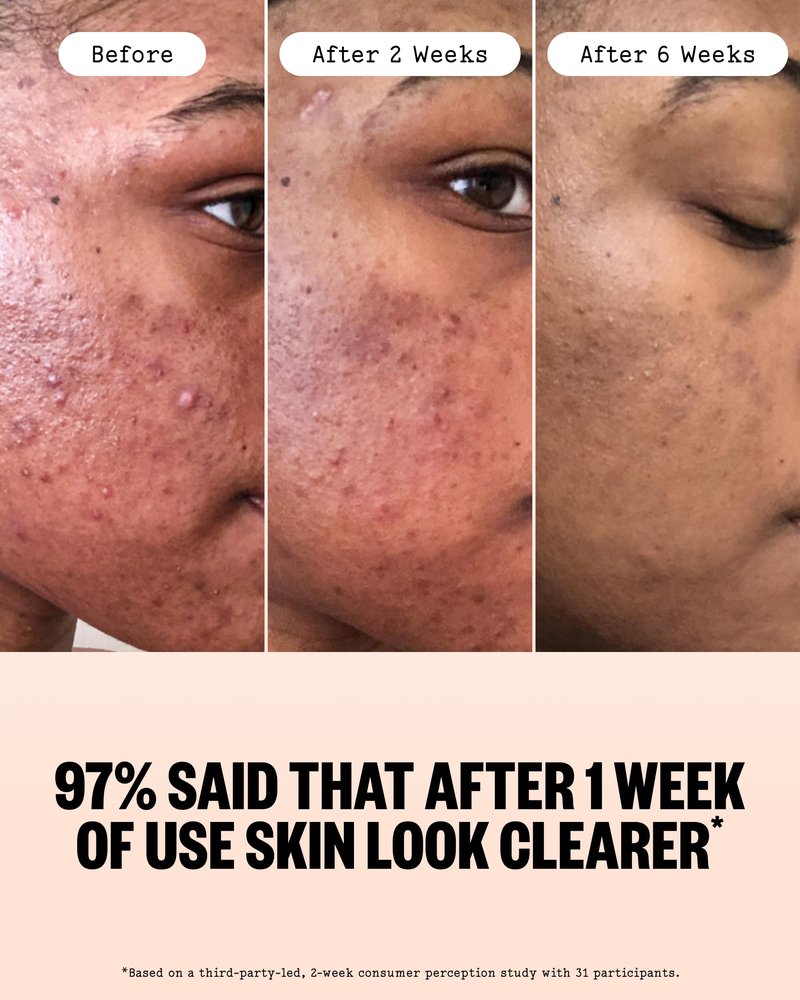 PEACE OUT Acne Serum with 2% Salicylic Acid and Niacinamide, Daily Acne Face Treatment to Help Unclog Pores, Reduce Pimple Breakouts, Blackheads, and Improve Skin Texture (1 fl oz)