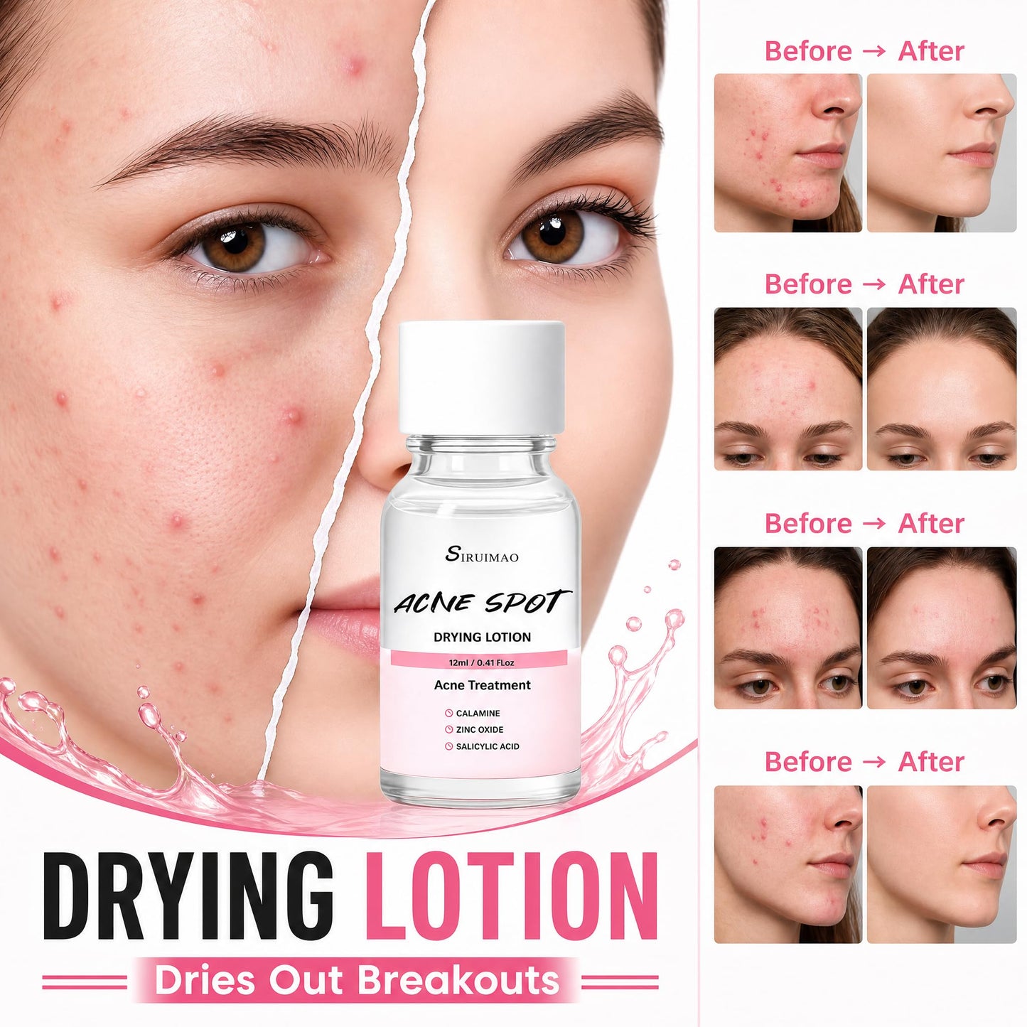SIRUIMAO Premium Drying Lotion with Swab, Overnight Solution For Face and Body, Dry Out Pimples, Blemishes, Zits And Clean Pores, 12ml / 0.41 FlOz