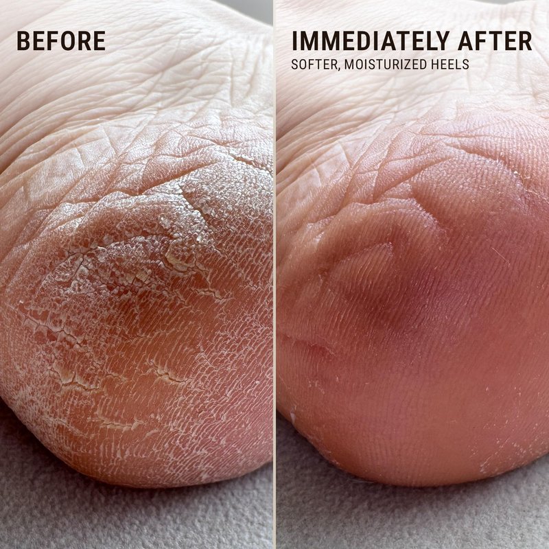 VOESH Heel Repair Duo, Solemate Heel Repair Balm & Moisturizing Heel Socks, Cracked Heel Stick Balm, Foot Care for Men & Women, At-Home Foot Care, Fuzzy Heel Socks, Toeless Spa Socks