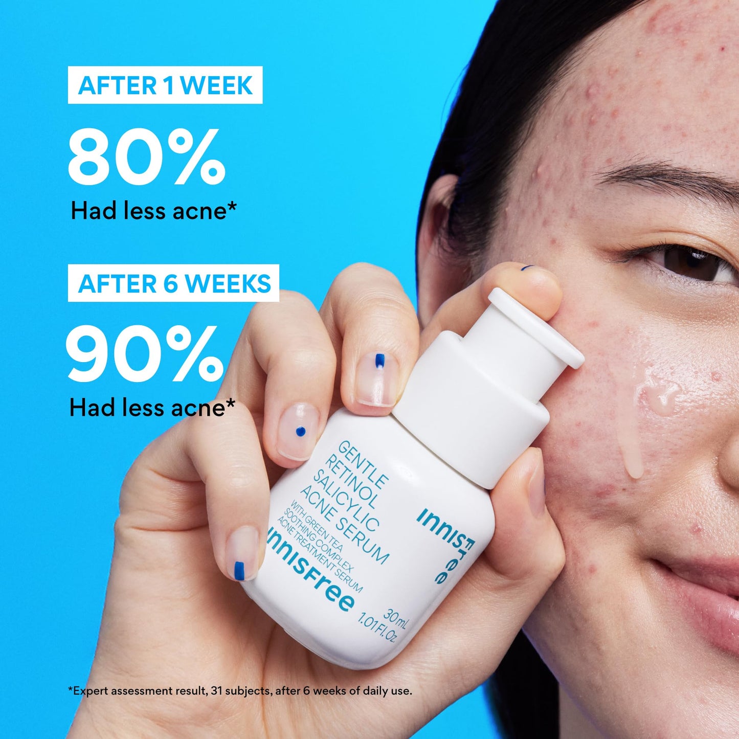 innisfree Gentle Retinol Salicylic Acne Serum | Korean Face Treatment with Niacinamide and Ceramides for Blemishes and Clear Skin