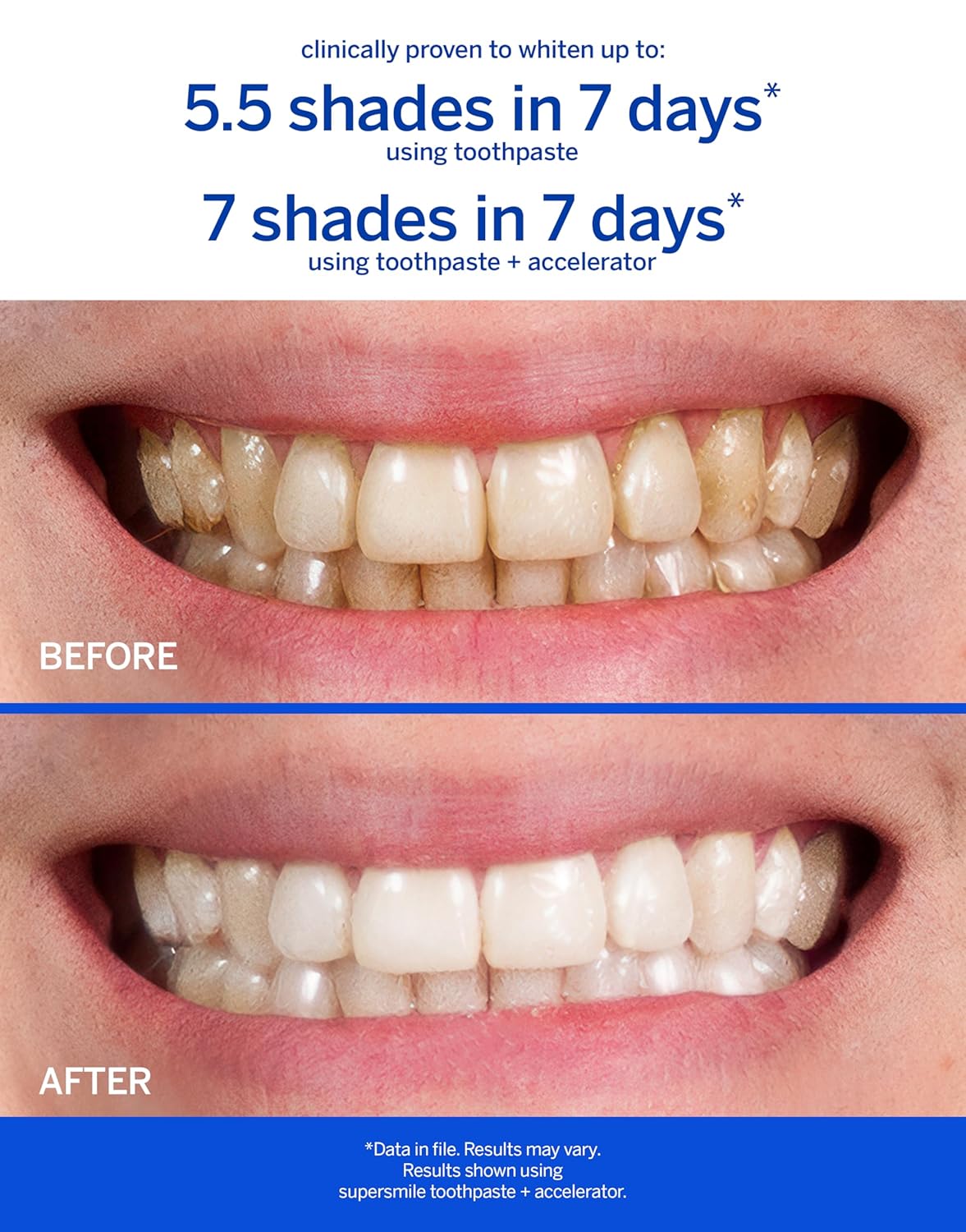 Supersmile Professional Whitening Toothpaste Bundle - Enamel-Safe Cinnamon Flavor for Sensitive Teeth | Accelerator Included