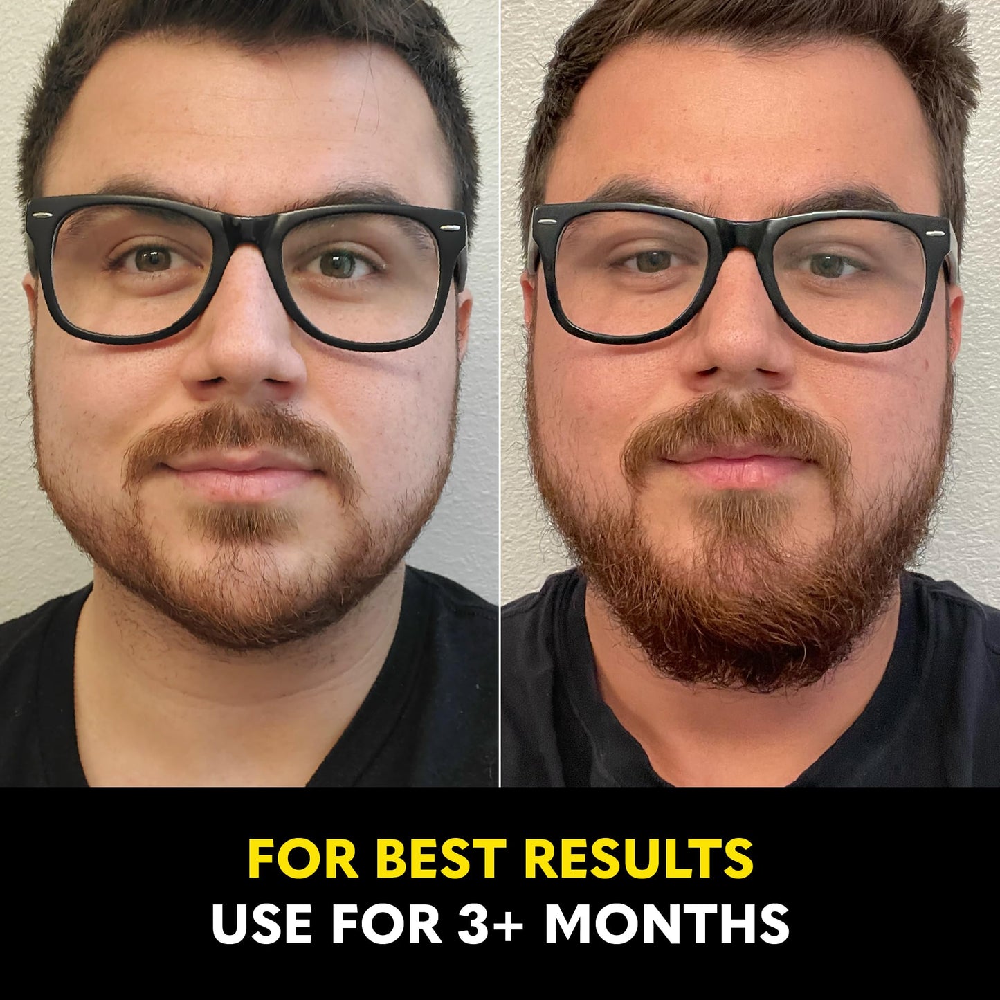 The Beard Club - Beard Growth Vitamins - Support A Thicker Fuller Beard, Fill in Patches - Minerals & Multi-Vitamins Help Support and Stimulate Healthier Facial Hair Growth