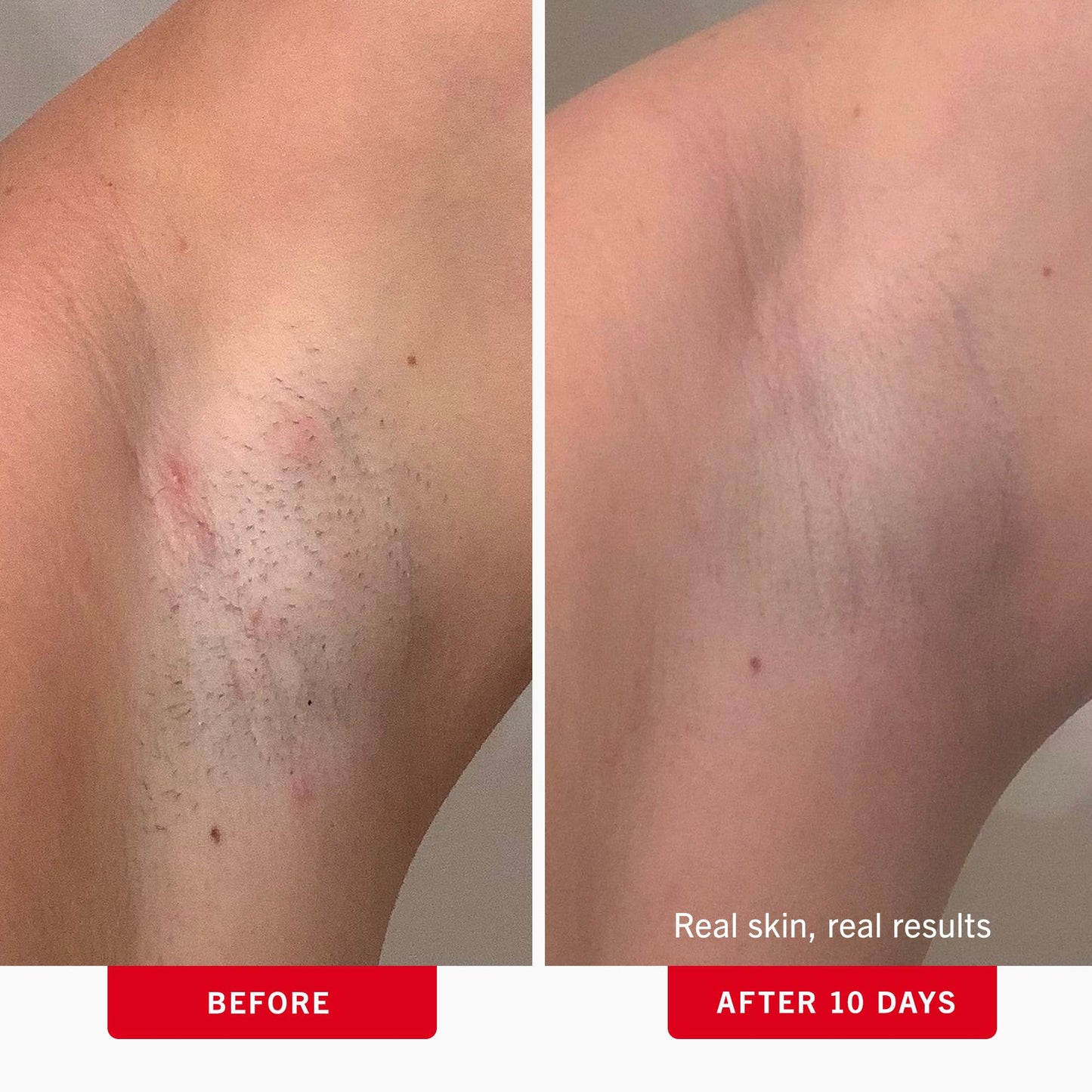 First Aid Beauty - Ingrown Hair Pads with BHA + AHA - Aftershave Treatment Pads Help Men & Women Prevent Razor Bumps, Exfoliate Underarms & Bikini Area, Compostable for Daily Use - 3ct, 84 Pads Total