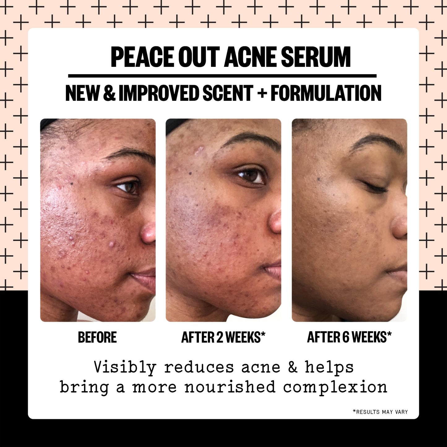 PEACE OUT Skincare Acne Serum. Daily Multi-Benefit Face Serum with 2% Salicylic Acid to Target Pimples, Zits, Blemishes and Breakouts, For Clearer-Looking Skin 1 fl oz