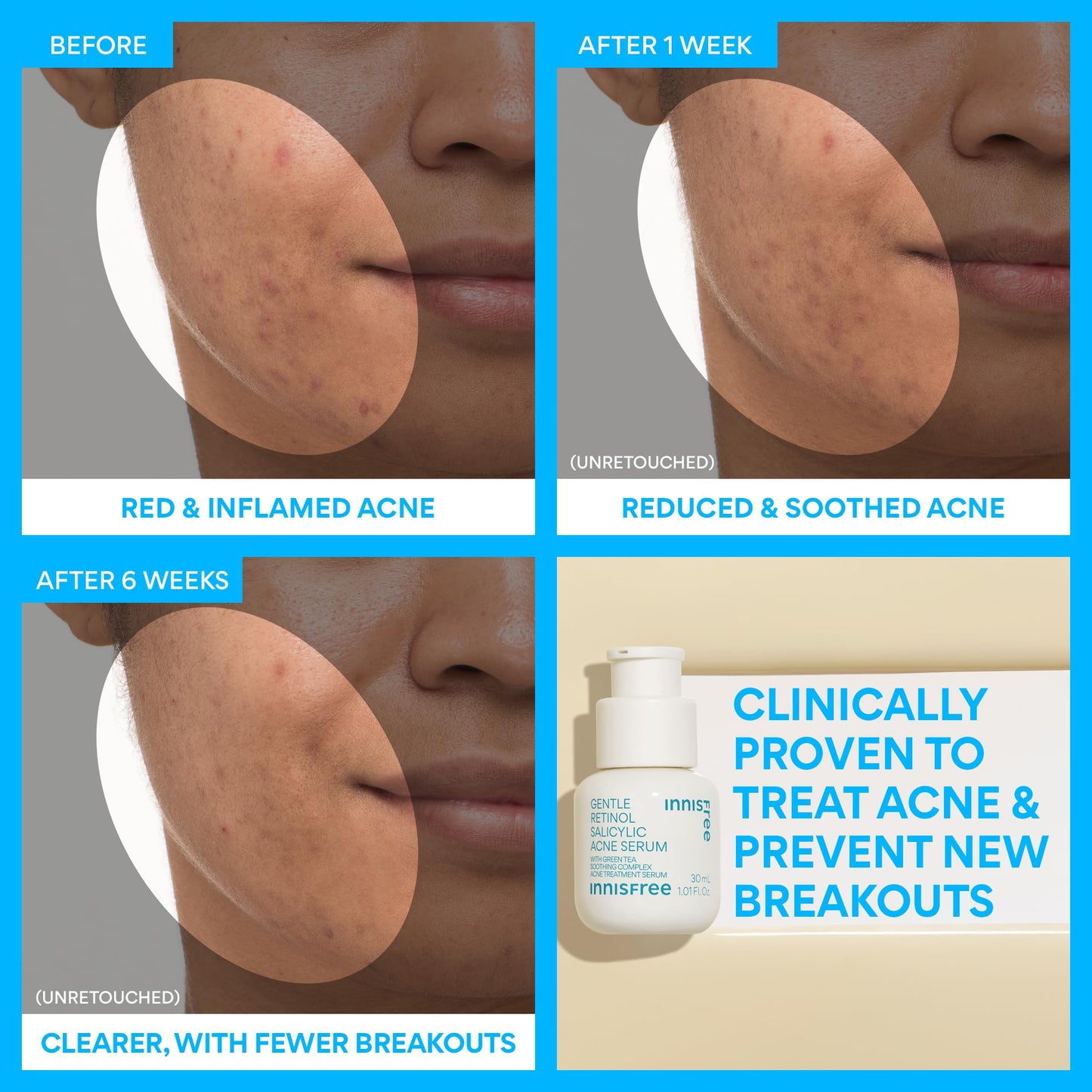 innisfree Gentle Retinol Salicylic Acne Serum | Korean Face Treatment with Niacinamide and Ceramides for Blemishes and Clear Skin