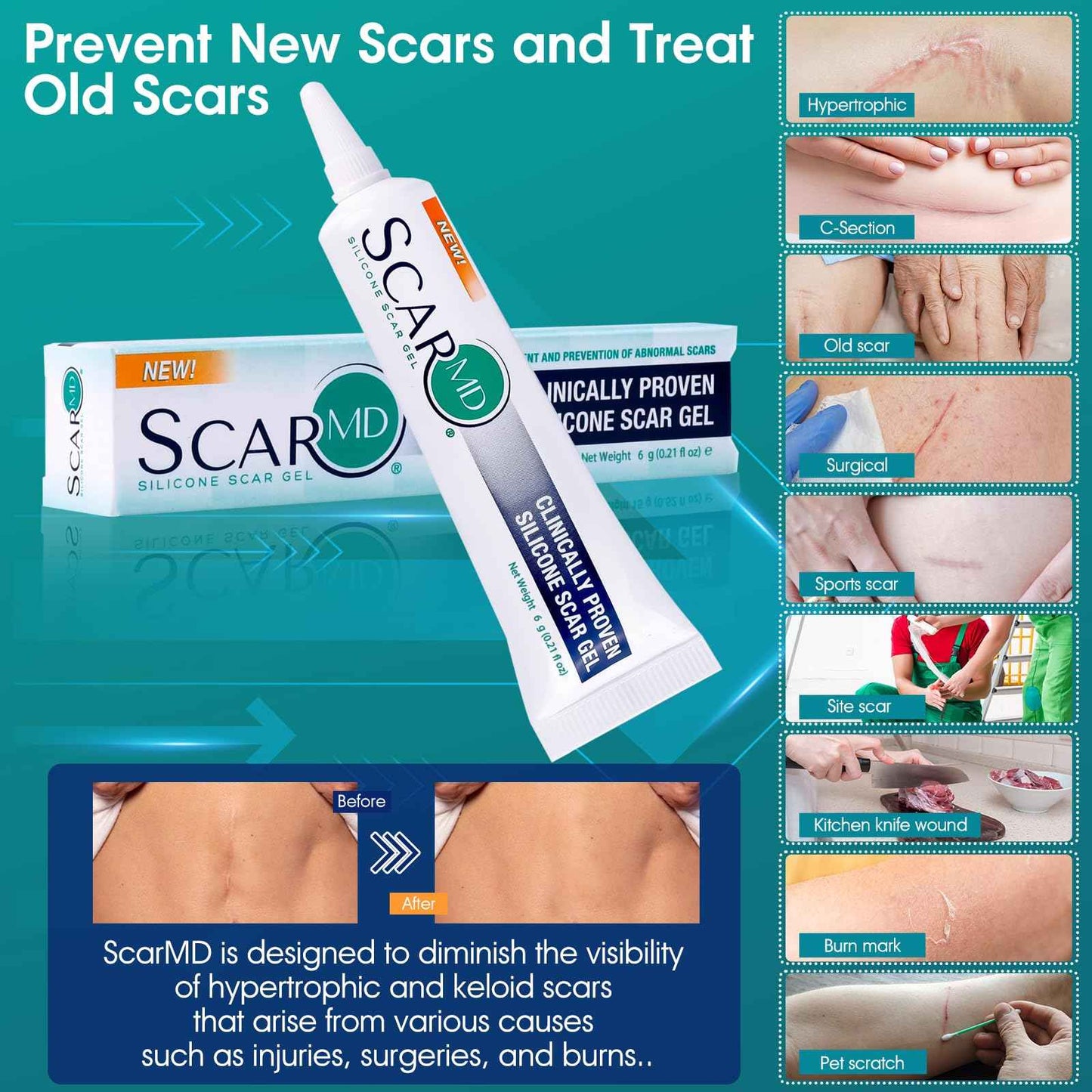 Scar Gel Scar Cream, Keloid Bump Removal, Advance Scar Gel for Surgical Scars,Body,Leg, Burns,C-Section, Stretch Marks, Reduces Discomfort, 0.21oz